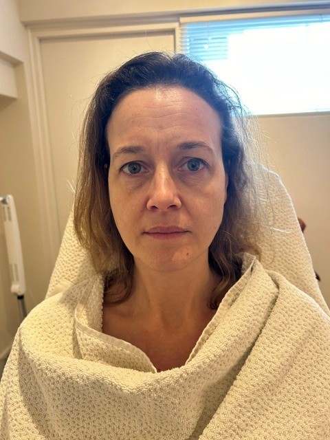 Yvonne voor de Bio-Lift behandelingen