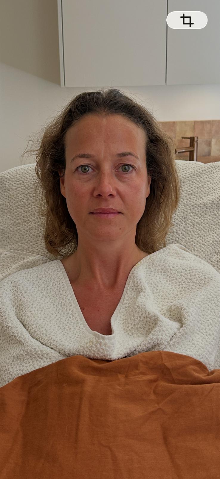 Yvonne na de Bio-Lift behandelingen