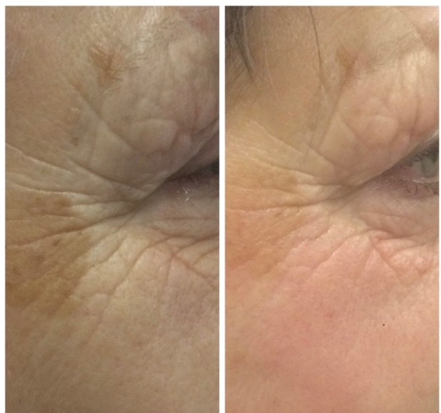 Resultaat Bio-Lift Start Kuur bij Ardie