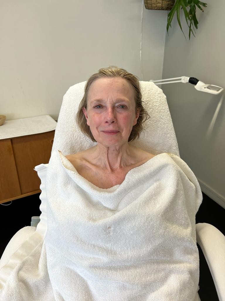 Carla na de Bio-Lift Start Kuur
