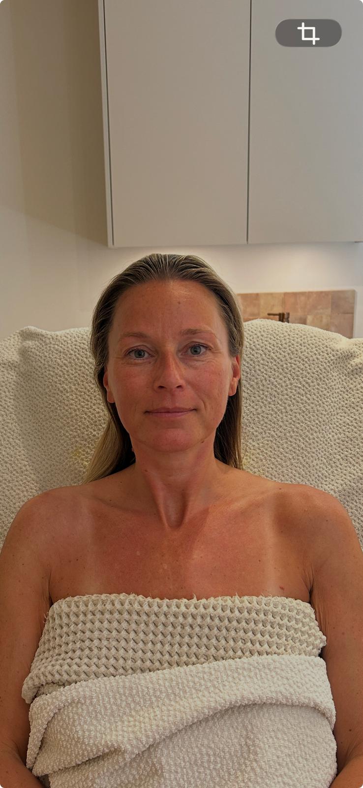 Claudia na de Bio-Lift behandelingen en microneedling