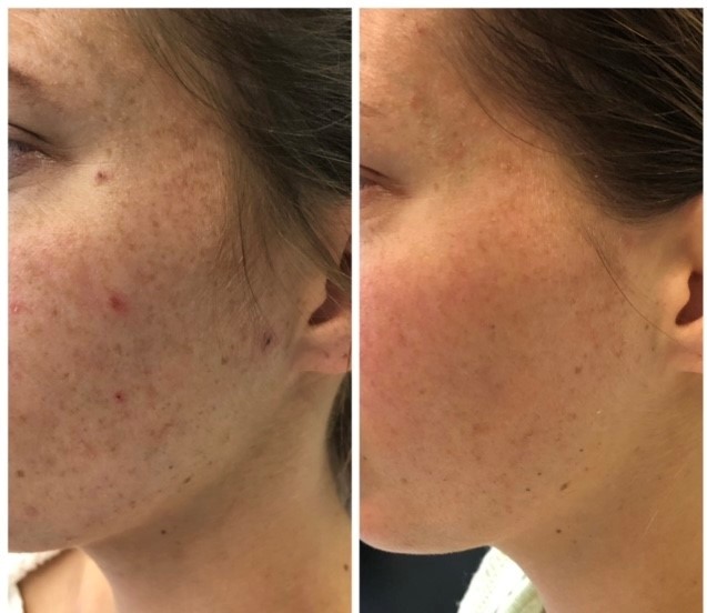 Resultaat microneedling bij Danique — doffe huid met pigment