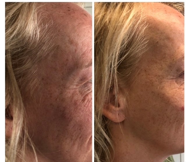 Resultaat Bio-Lift Start Kuur bij Esther