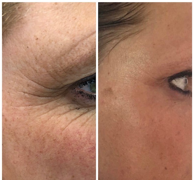 Resultaat BioSkinJetting bij Inge