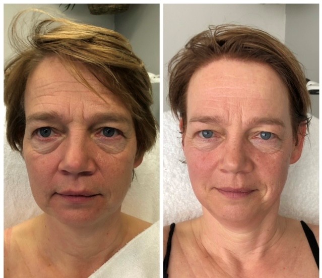 Resultaat Bio-Lift Start Kuur bij Jolanda — salon Eindhoven