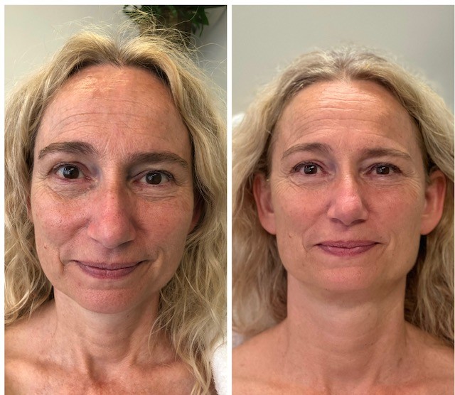 Resultaat Bio-Lift behandeling bij Mirjam