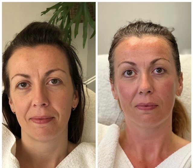 Resultaat Bio-Lift Start Kuur bij Saskia — natuurlijke huidverjonging